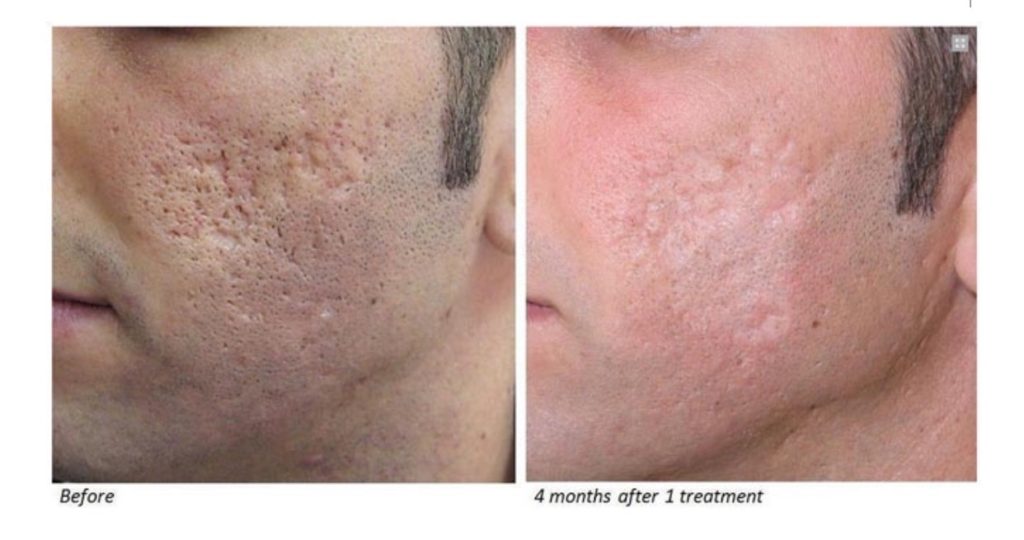 fullsizerender1 Horizon Dermatology & Cosmetic Center