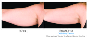 Coolsculpting Before and After Arm