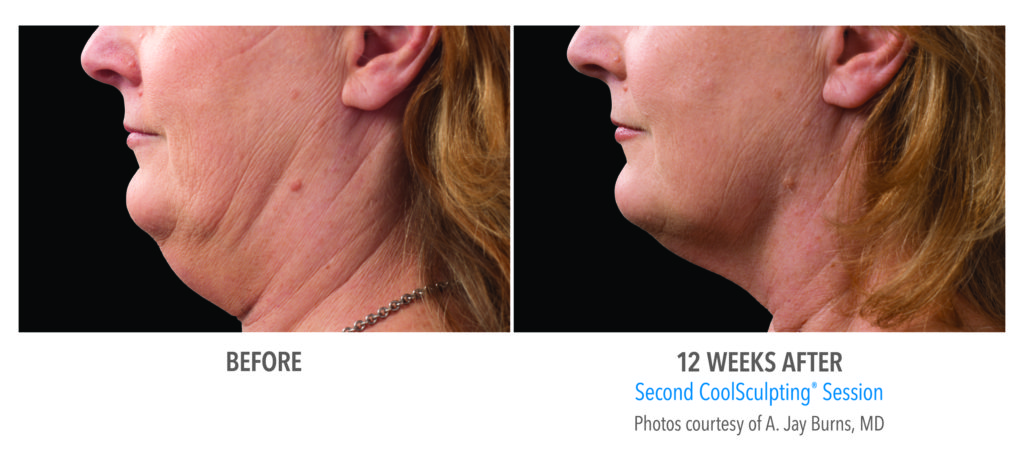 Before and After Chin Coolsculpting 