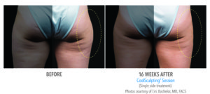Coolsculpting Before and After Thigh 2