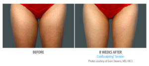 Before and After Thigh Coolsculpting 