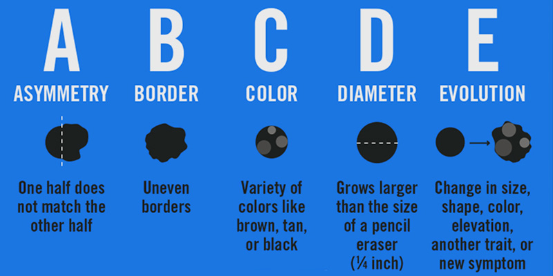 ABCDEs of Melanoma 1